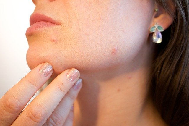 Can SIBO Cause Acne? The Role of Gut Health
